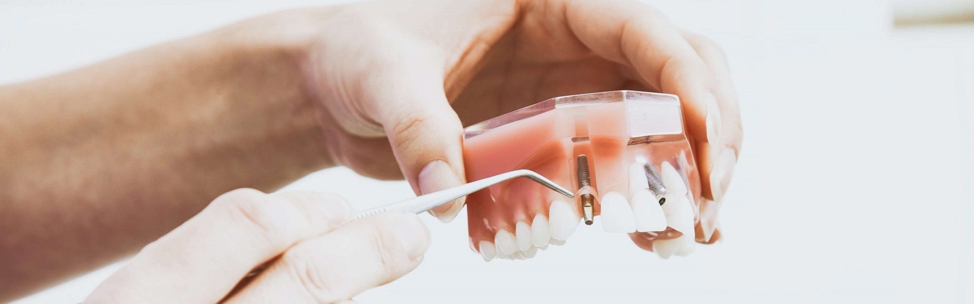 Kesice Za Kafu | Zubni implanti Beograd